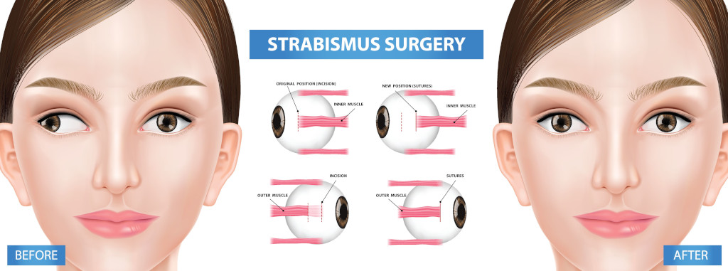 Strabismus Surgery Small Red Rock Ophthalmology